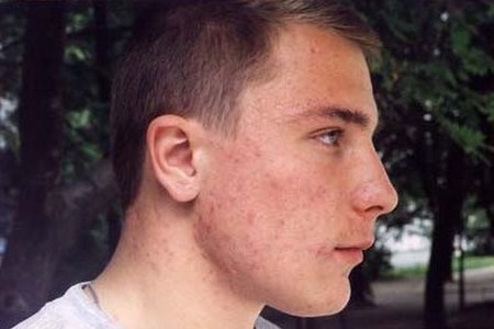 Из за чего выходят прыщи на висках Из за чего выходят прыщи на висках