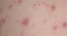 Rash on the body of an adult photo with explanations of what it could be