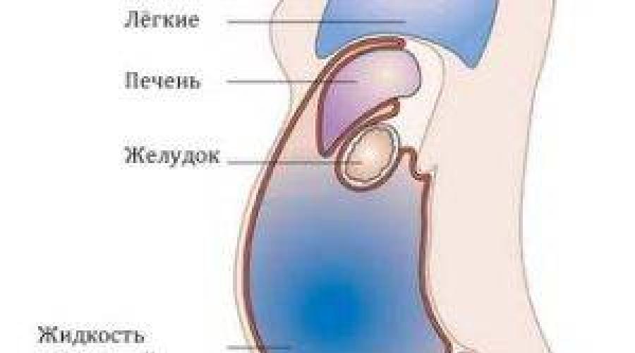 Асцит откачивание жидкости. Скопление жидкости в брюшной полости называют. Асцит брюшной полости причины. Жидкость в брюшной полости (асцит). Скопилась жидкость в брюшной полости.