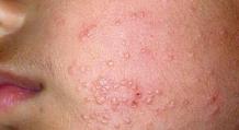 Features of the rash with hiv, AIDS