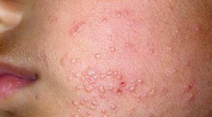Features of the rash with hiv, AIDS