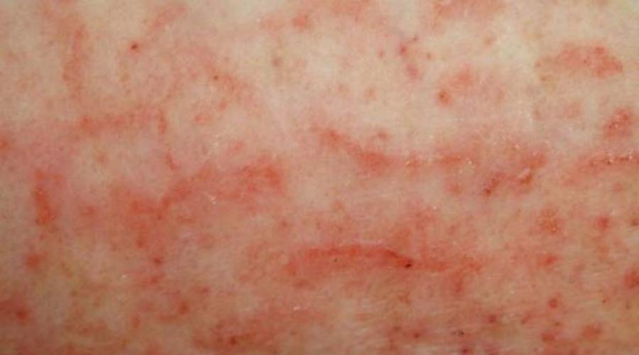 Дерматоз — что это такое? Аллергический зудящий дерматоз: симптомы и лечение, фото негативных симптомов на кожных покровах, эффективные методы устранения зуда и высыпаний.