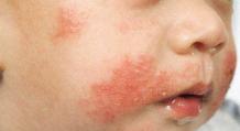 The concept of dermatitis and ways to get rid of itching