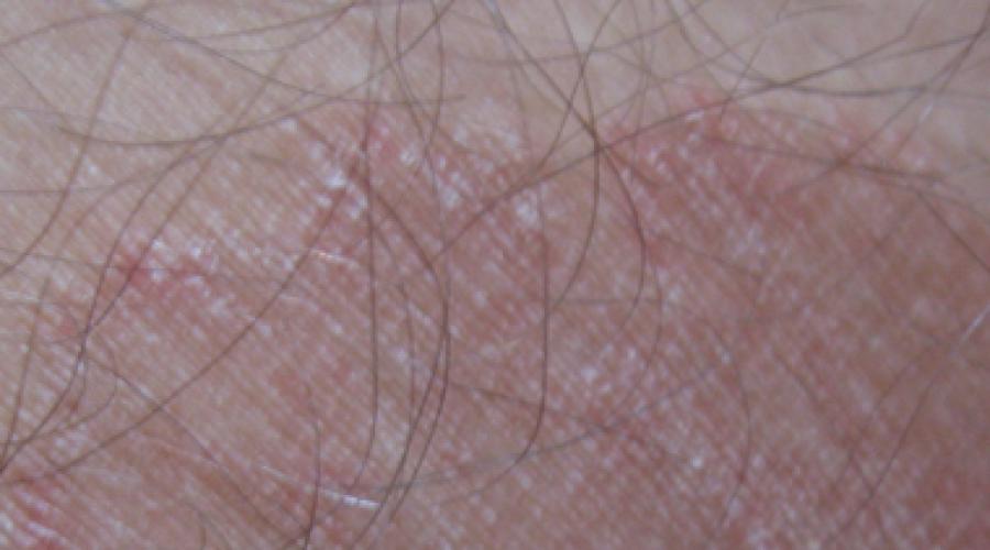 Шелушение кожи между ног в паху. Причины и факторы риска. Внешние факторы раздражения