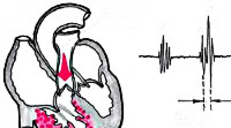 القلب الرئوي.  القلب الرئوي المزمن: العلامات السريرية والتوصيات للعلاج كيف يتم تنظيم الضغط في الأوعية الرئوية