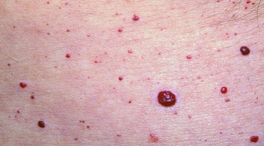 Красные кровяные пятна на коже: нужно ли их лечить. Красные точки на лице: как убрать мелкую сыпь?