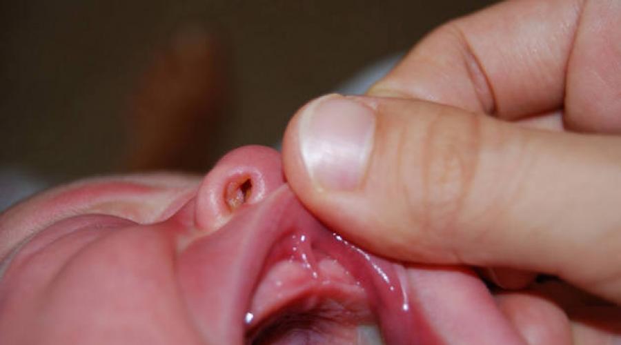 اللجام بين الأسنان العلوية عند الأطفال.  صعوبات في الرضاعة.  فرينول الشفة السفلى