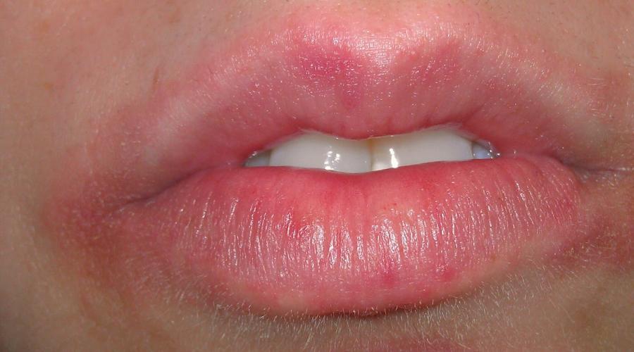 لماذا يتقشر الجلد حول الفم وماذا تفعل حيال ذلك