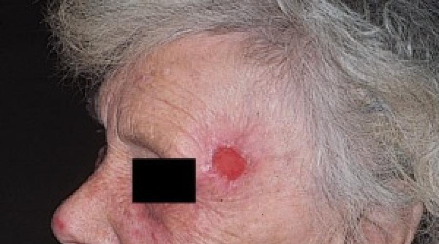 Лучевое повреждение кожи или радиационный дерматит. Степени облучения кожи. Влияние жесткого излучения на кожу Причины развития рака кожи