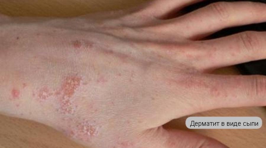 How is itchy dermatitis.  Ways to get rid of itching