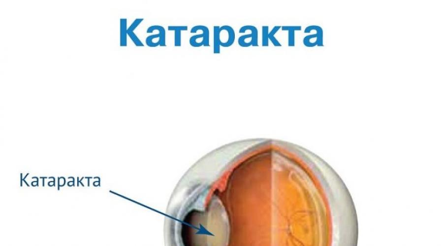 Список лучших глазных капель от катаракты: самые эффективные средства. Капли для глаз после операции Капли для глаз после операции