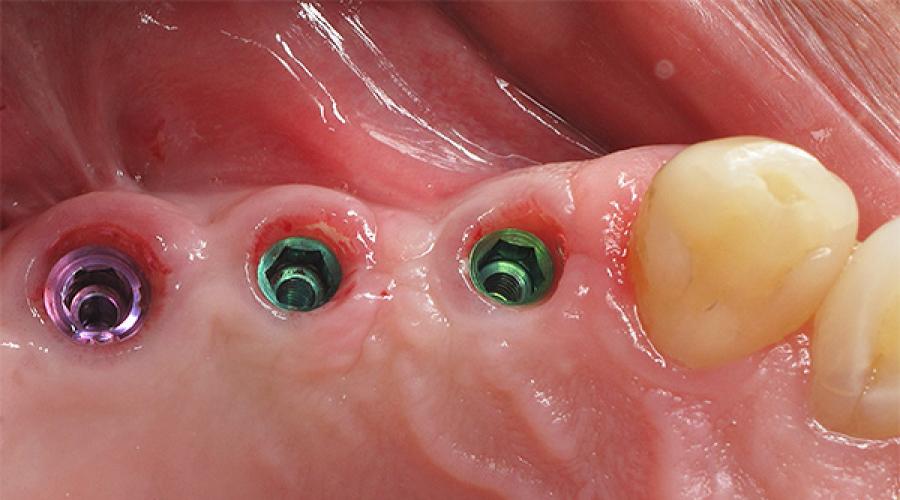 المضاعفات والمشاكل التي تحدث أحيانًا بعد زراعة الأسنان.  كيف يتم تركيب الغرسات على الفك العلوي - طرق ومراحل الزرع كيف يمكنني ترميم الاسنان العلويه الامامية