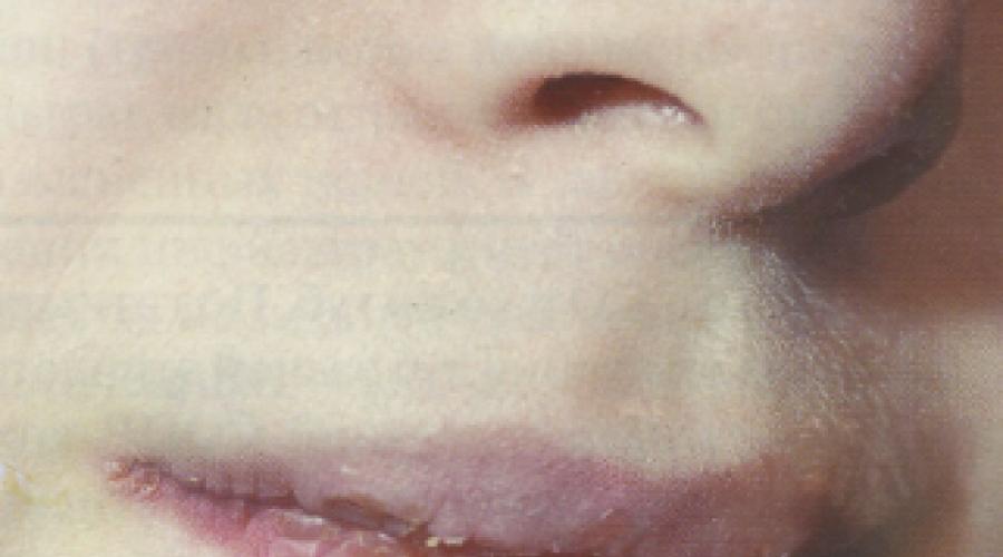 Почему воспаляется слизистая верхней губы. Симптомы и признаки хейлита слизистой, кожной оболочки и красной каемки губ