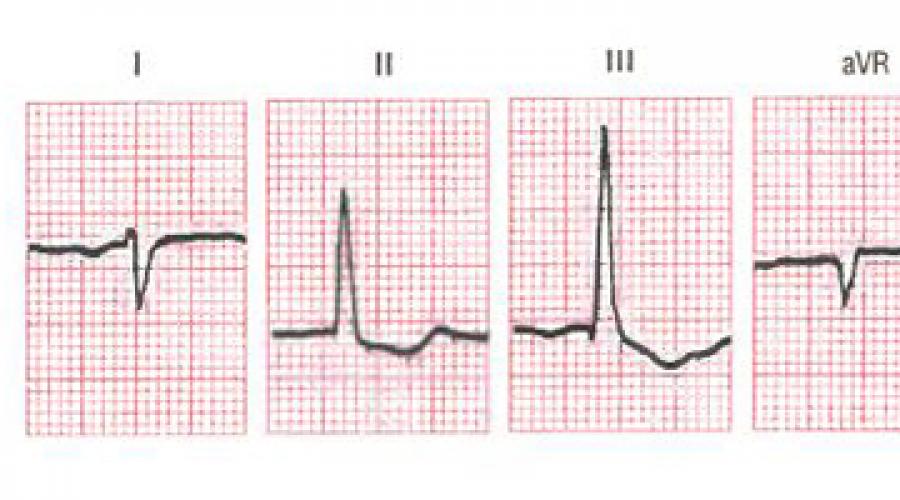 Что значит электрическая ось сердца отклонена влево. Определение положения электрической оси сердца. Повороты сердца вокруг переднезадней оси. Направления оси и ее смещение