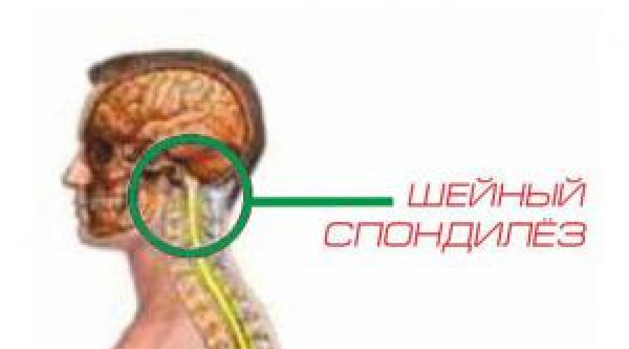 Шейного отдела позвоночника мкб 10