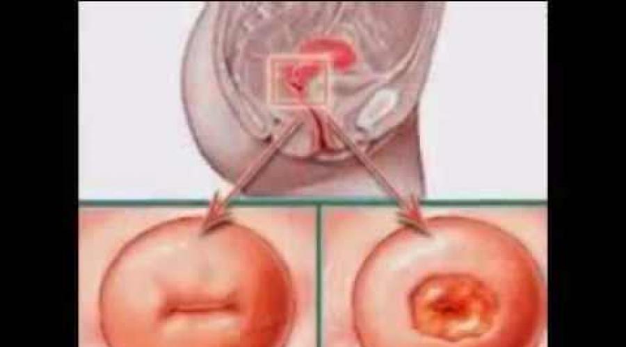 اكتروبيون عنق الرحم الجرثومية 10. اكتروبيون.  العيادة (الأعراض) والتشخيص والعلاج.  مراحل تطور التقرح