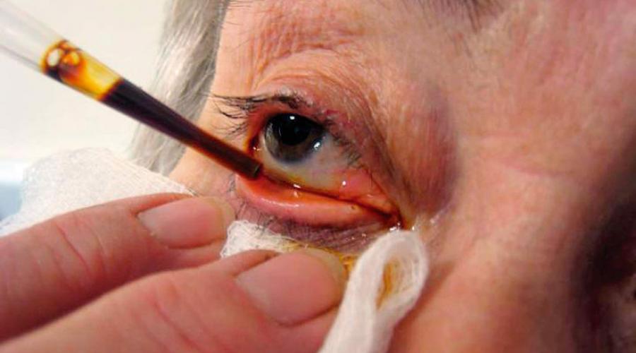 فقدان الرؤية بعد جراحة استبدال العدسة.  أسباب وعلاج إعتام عدسة العين الثانوي بعد استبدال العدسة.  سحابة أمام العين بعد جراحة الساد - يمكن إزالتها بالليزر