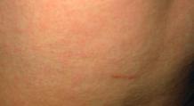 A very small rash on the body is a sign of the disease