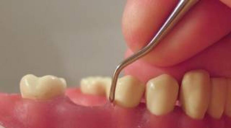 علاج الجيب دون كشط.  التدخل الجراحي في طب الأسنان - الكشط: ما هو ، التكنولوجيا والنتيجة.  كشط الجيوب والأسنان