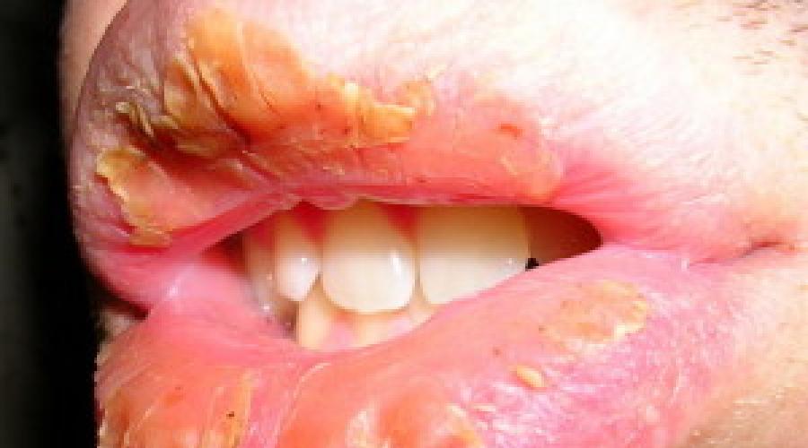 Клинические проявления самостоятельных заболеваний губ. Воспаление слизистой оболочки и кожи губ, хейлит
