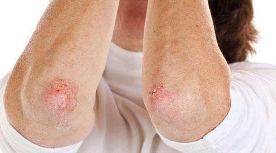 Vse, česar niste vedeli o srbečem dermatitisu