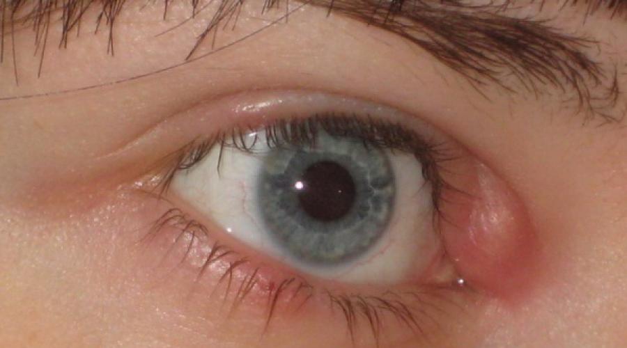 Чешется верхнее веко глаза что делать. Заболевания, при которых чешутся глаза. Конъюнктивит или ячмень.