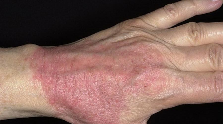 Зудящие аллергические дерматозы атопический дерматит нейродермит. Зудящие аллергические дерматозы: причины появления и диагностика. Простое подострое пруриго.