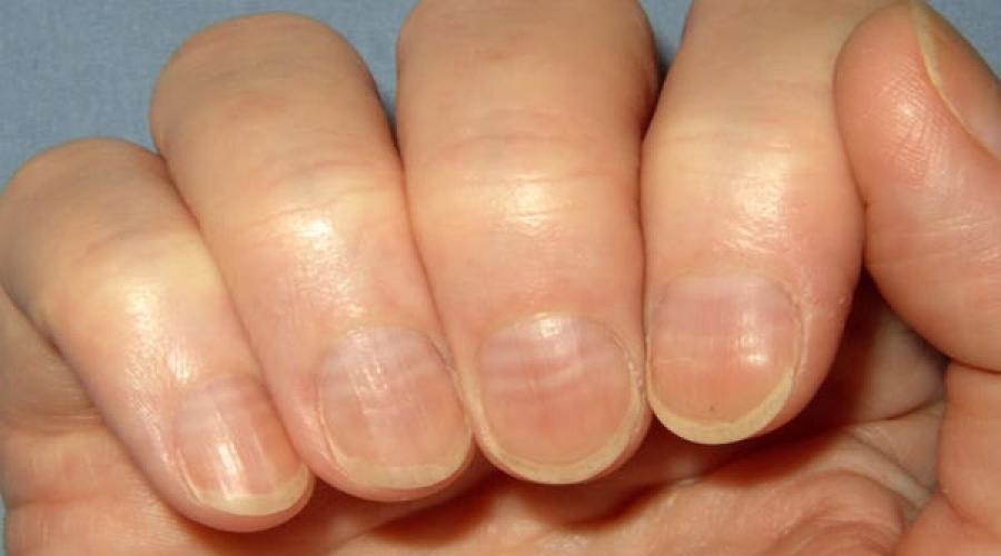 Ногти буграми причины и лечение. Почему появляются бороздки на ногтях и как вернуть природную красоту ногтя