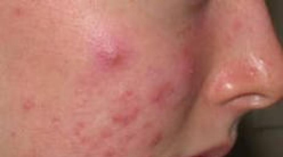 Аллергия у вич инфицированных. Кожные проявления спида