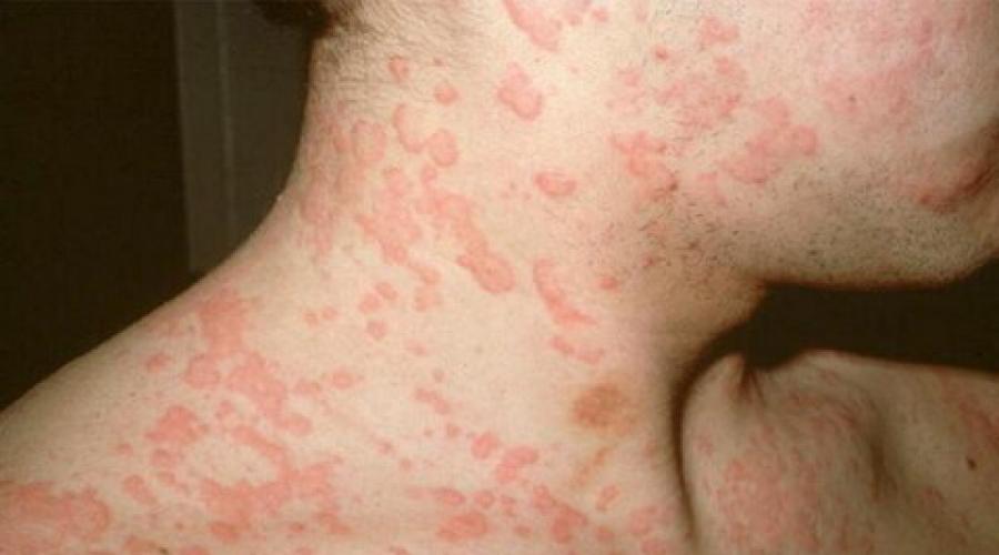 На коже появились красные пятна и чешутся. Пищевая и контактная аллергия. Что необходимо делать при раздражении