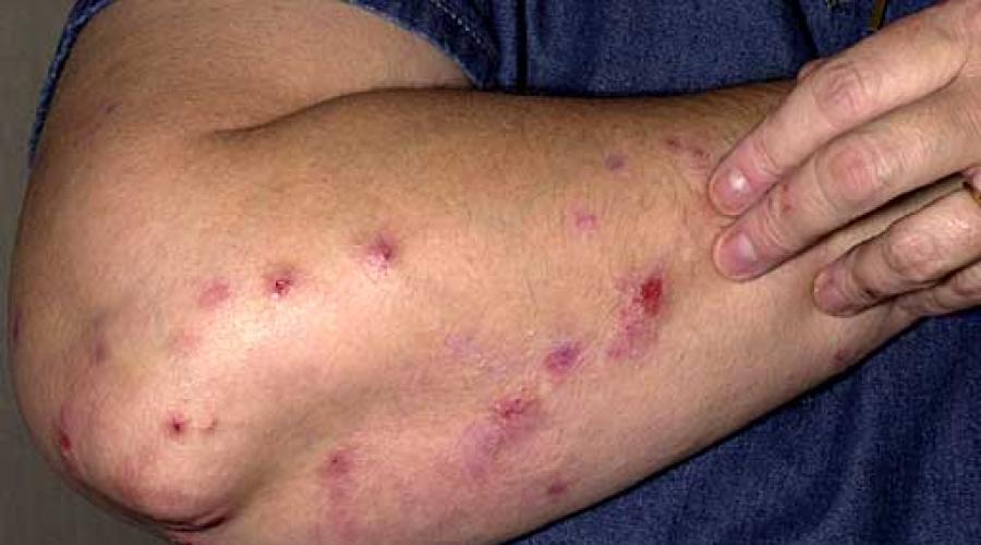 What can cause itchy dermatoses?