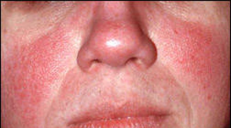 علاج الوردية الحمامية.  كيف تبدو الوردية على الوجه: الصورة.  فيديو: مرض جلدي الوردية.