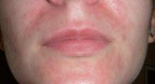 Príčiny a liečba podráždenia kože okolo úst