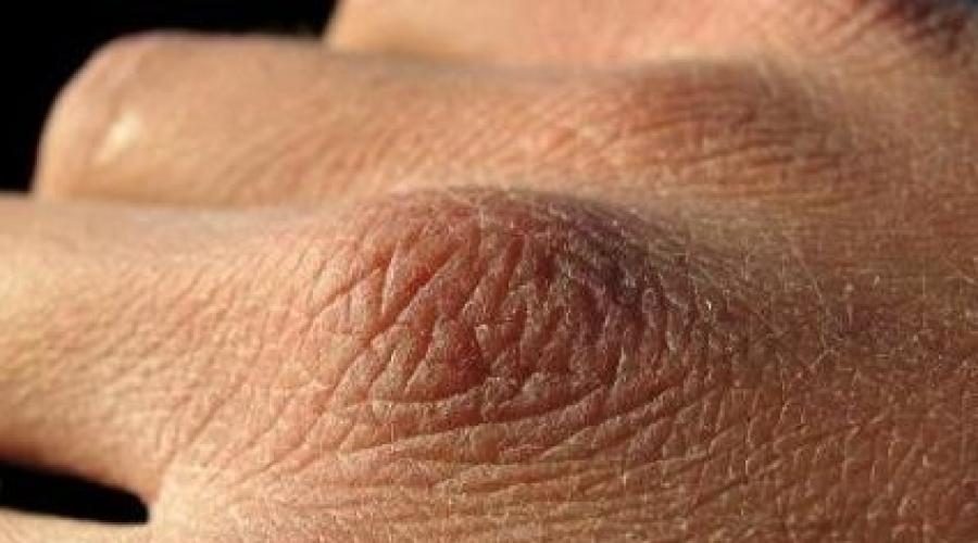كيفية إصلاح الأيدي الجافة جدًا.  بشرة اليد شديدة الجفاف: ماذا أفعل؟  العلاجات التجميلية والشعبية للعناية بالبشرة