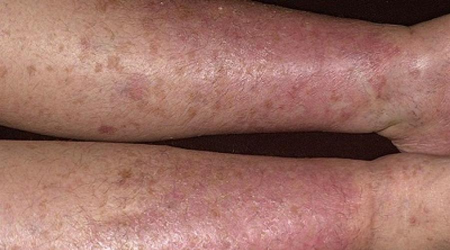 التهاب الجلد التماسي على القدم عند البالغين.  كيفية اختيار مرهم لعلاج التهاب الجلد في الأطراف السفلية