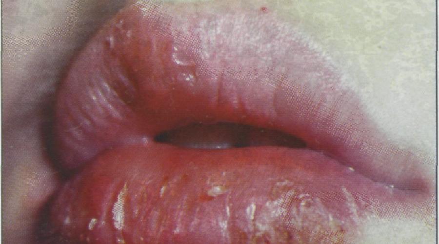 Жжение над верхней губой. Клинические проявления самостоятельных заболеваний губ
