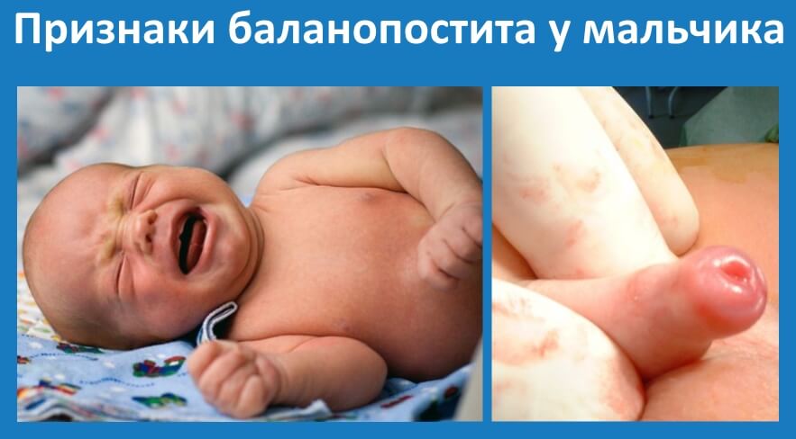 Защемление плоти головки у ребенка фото Защемление плоти головки у ребенка фото