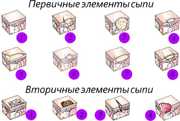 Элементы сыпи. Первичные и вторичные элементы кожной сыпи. Первичные морфологические элементы кожной сыпи. Первичные и вторичные морфологические элементы кожной сыпи. Вторичные элементы кожной сыпи.