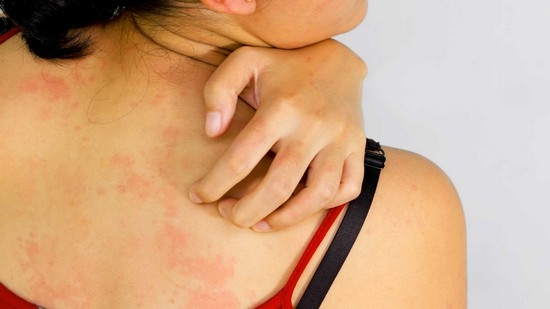 The body itches in different places with and without a rash: causes and treatment