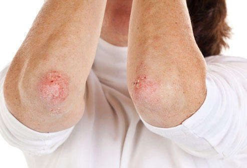 Vše, co jste nevěděli o svědivé dermatitidě