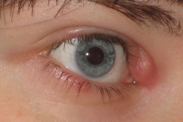 Itching of the upper eyelid, possible causes and treatment