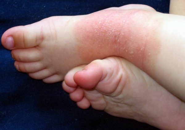Why can your feet itch a lot?