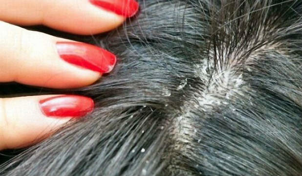 Srbenje lasišča in izpadanje las - prepoznavanje vzrokov in načinov zdravljenja
